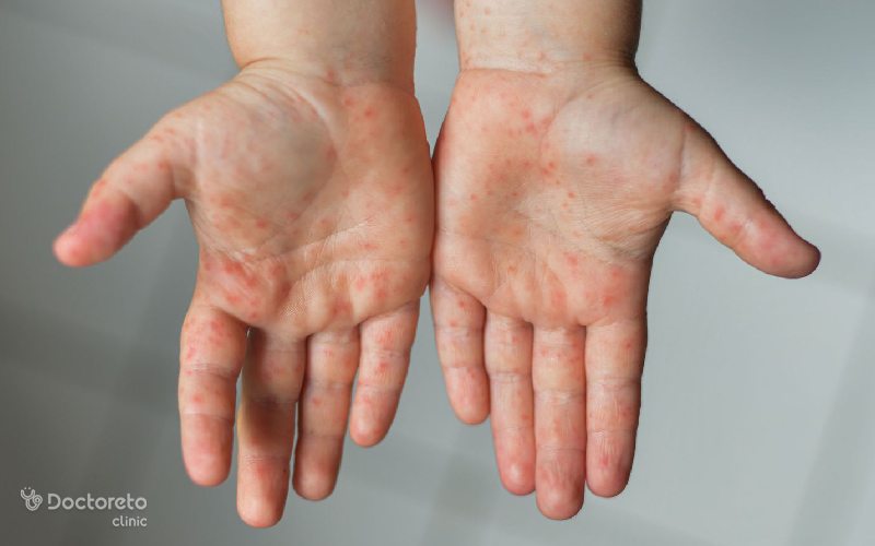 همه چیز درباره علائم و روش درمان عفونت با ویروس کوکساکی