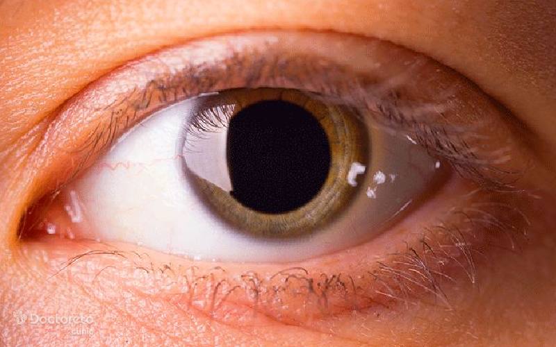 اتساع یا گشادی مردمک چیست و چرا ایجاد میشود؟