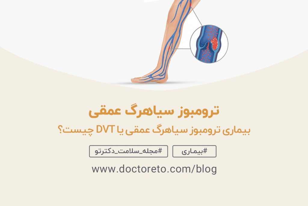 ترومبوز سیاهرگ عمقی