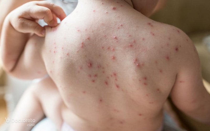 آبله مرغان چیست و چگونه درمان می شود؟ روش های پیشگیری از ابله مرغون