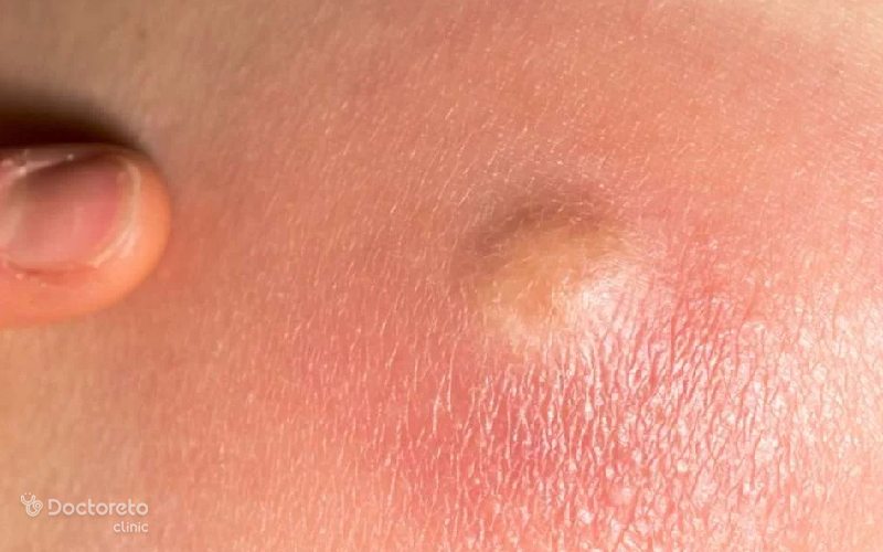 کورک چیست و چگونه از ایجاد آن پیشگیری کنیم؟
