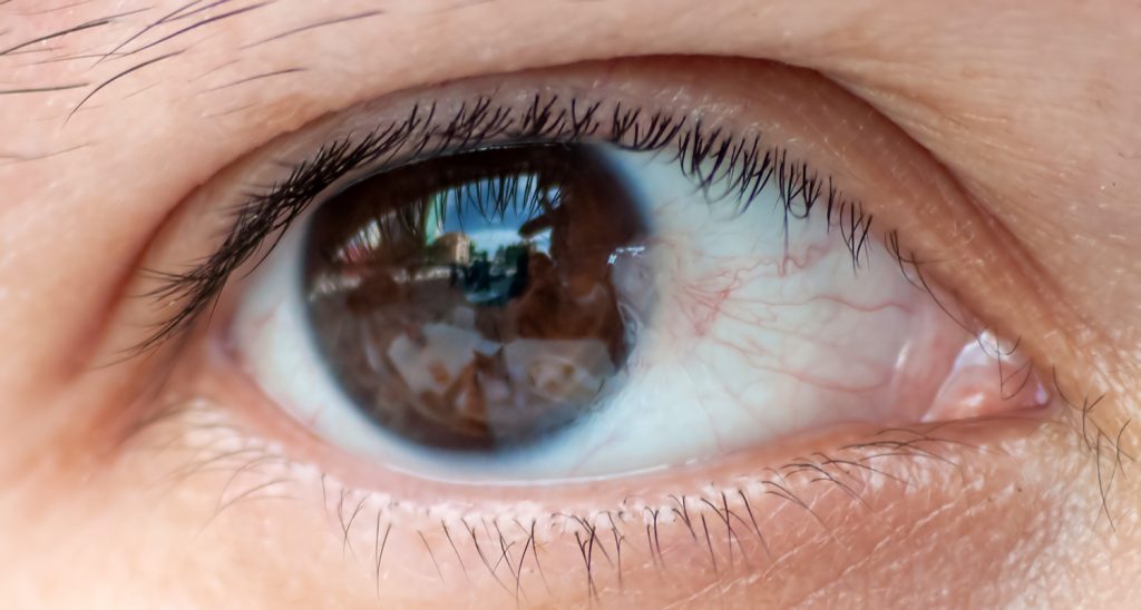 Pterygium-surgery