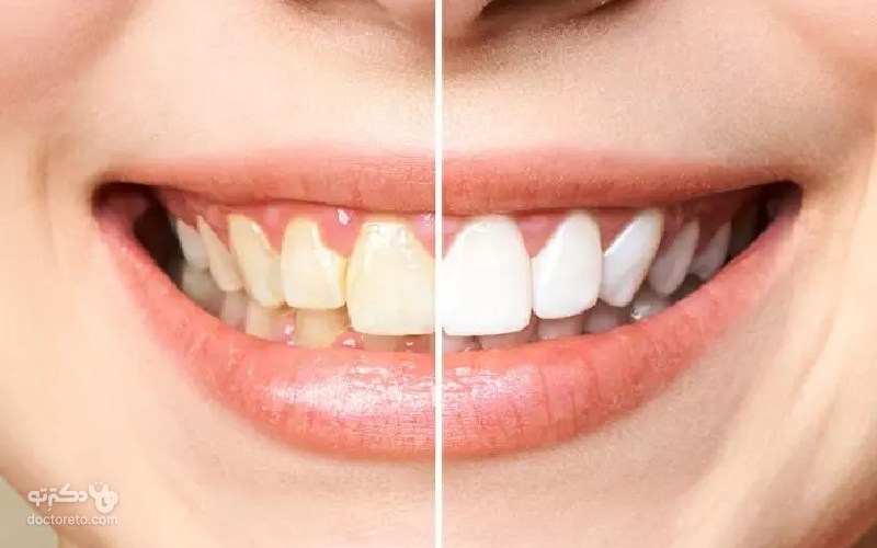 بلیچینگ دندان چیست؟
