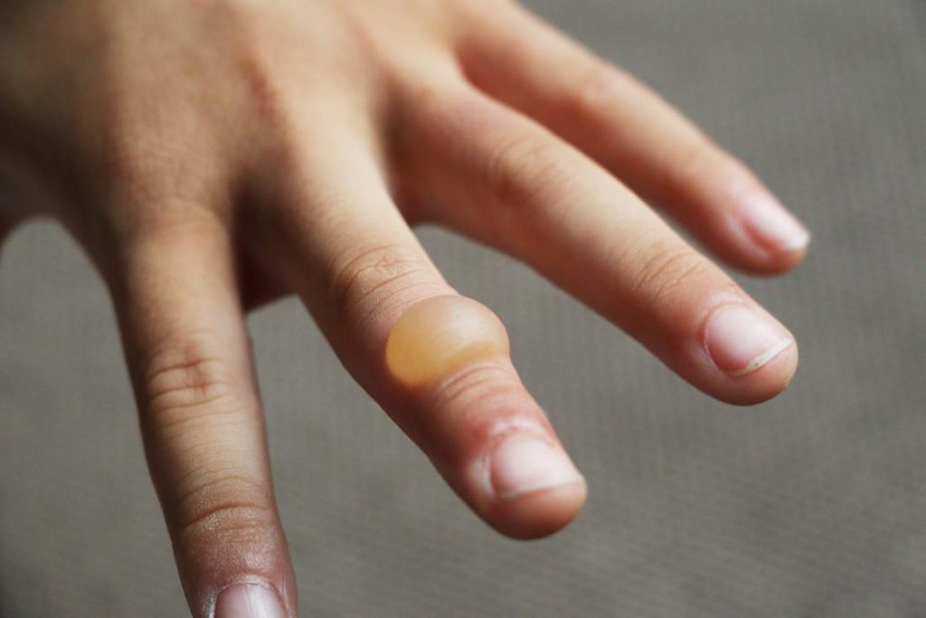 Blister on hand