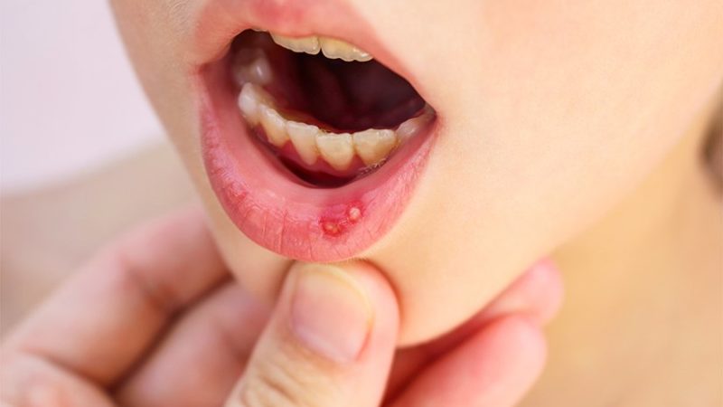 Mouth and lip blisters