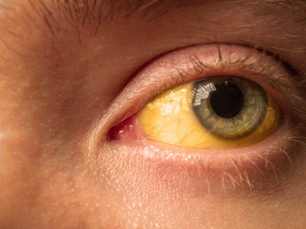 jaundice