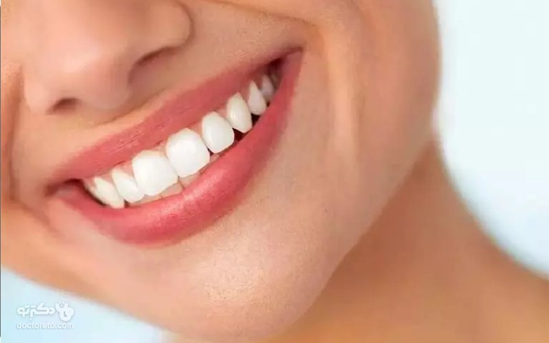 لمینت کامپوزیتی چیست