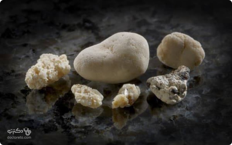 انواع سنگ کلیه