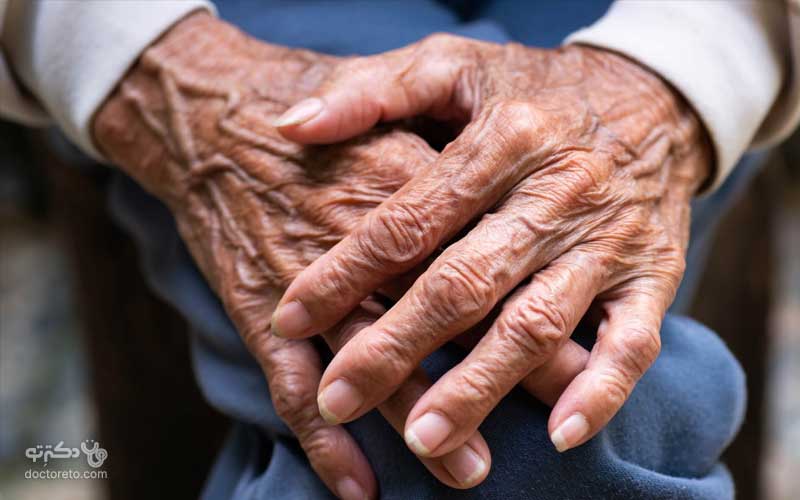 واریس دست چگونه ایجاد می‌شود؟