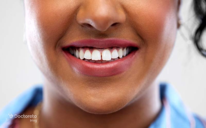لمینت دندان خرگوشی، نحوه انجام، مزایا و معایب آن