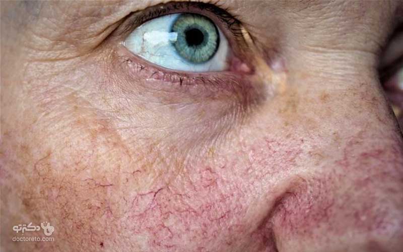 واریس صورت چیست و چگونه آن را درمان کنیم؟