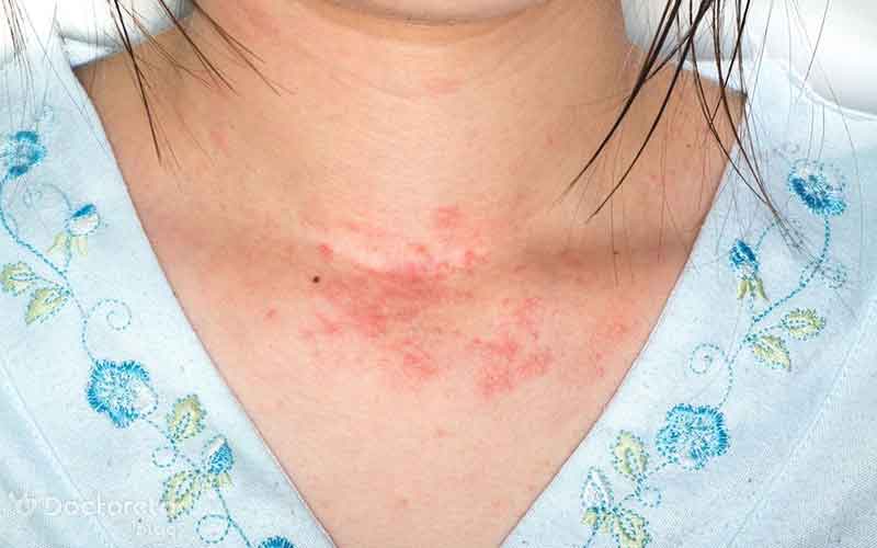 آیا زونا خطرناک است؟