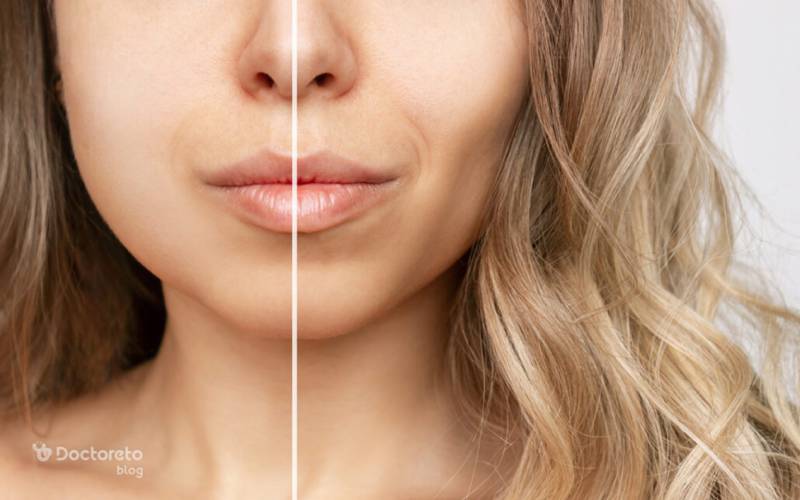 آیا جراحی لیپوفیس همان بوکال فت غبغب است؟