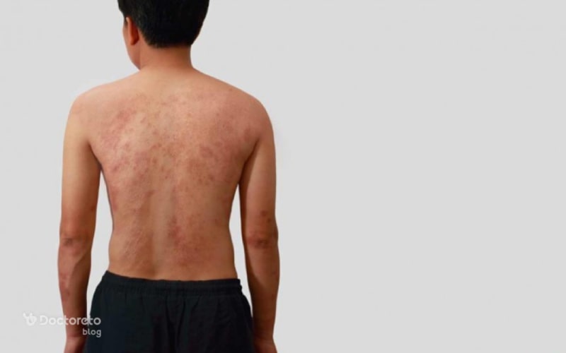 انواع درماتیت تماسی