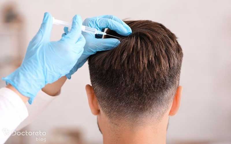 مزوتراپی بعد از کاشت مو